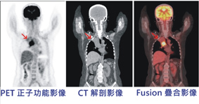 見微知著   儘早防堵-全身正子掃描癌症篩檢(相關圖片)