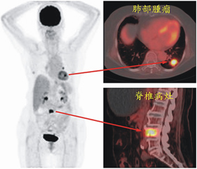 見微知著   儘早防堵-全身正子掃描癌症篩檢(相關圖片)