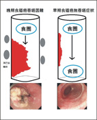 早期食道癌的診斷與治療方式(相關圖片)
