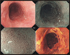 早期食道癌的診斷與治療方式(相關圖片)