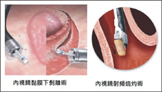 早期食道癌的診斷與治療方式(相關圖片)