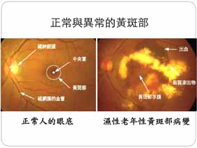我的世界扭曲了  搶救黃斑部病變(相關圖片)