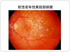 我的世界扭曲了  搶救黃斑部病變(相關圖片)