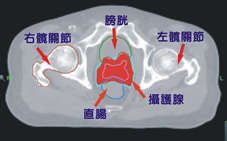 攝護腺癌放射治療的再突破(相關圖片)