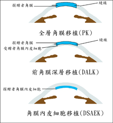 眼角膜移植的最新趨勢(相關圖片)