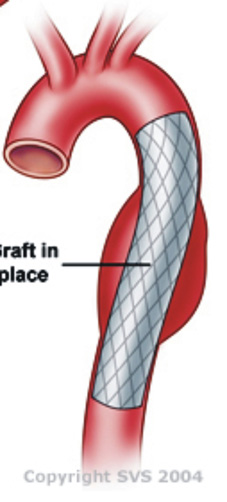 使用主動脈覆膜支架(Stent Graft)治療主動脈疾病(相關圖片)