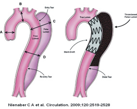 使用主動脈覆膜支架(Stent Graft)治療主動脈疾病(相關圖片)