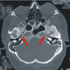 不可輕忽搏動性耳鳴(相關圖片)