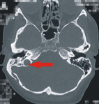 不可輕忽搏動性耳鳴(相關圖片)