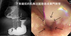 經口內視鏡括約肌切開術治療罕見吞嚥困難之疾病     「食道弛緩不能」(相關圖片)