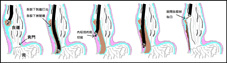 經口內視鏡括約肌切開術治療罕見吞嚥困難之疾病     「食道弛緩不能」(相關圖片)