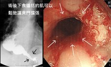 經口內視鏡括約肌切開術治療罕見吞嚥困難之疾病     「食道弛緩不能」(相關圖片)
