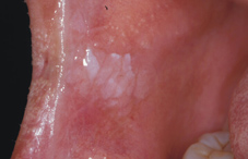 菸槍、紅唇族注意! 別讓口腔癌奪走你的健康人生！(相關圖片)