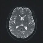 寒冷天氣容易誘發缺血性腦中風(相關圖片)