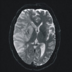 寒冷天氣容易誘發缺血性腦中風(相關圖片)