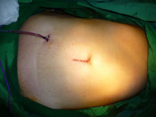 大腸直腸在微創手術的應用(相關圖片)