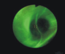 肺部的無情殺手-肺癌,你不可不知!      漫談肺癌診斷篇(相關圖片)