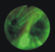 肺部的無情殺手-肺癌,你不可不知!      漫談肺癌診斷篇(相關圖片)