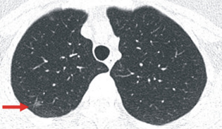 早期偵測國人健康隱形殺手肺癌的利器-- 低劑量電腦斷層(相關圖片)