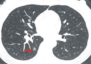 早期偵測國人健康隱形殺手肺癌的利器-- 低劑量電腦斷層(相關圖片)
