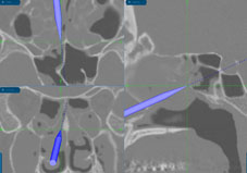 鼻竇炎手術最新的醫療技術介紹(相關圖片)