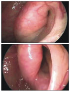 耳朵回音困擾可能是耳咽管開放症疾病(相關圖片)