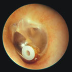 談耳咽管功能異常(相關圖片)