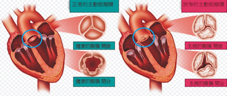 開刀換瓣膜 真的?還是假的?(相關圖片)