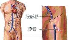 心律不整與電氣生理燒灼術(相關圖片)