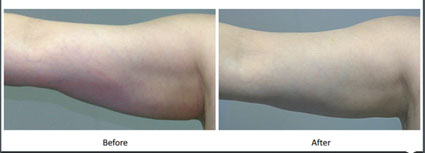 Reaction 電波系統   全身型高階體雕儀介紹(相關圖片)