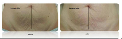 Reaction 電波系統   全身型高階體雕儀介紹(相關圖片)