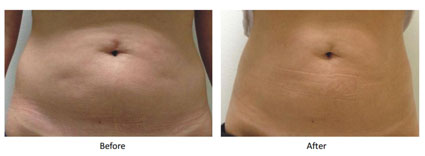 Reaction 電波系統   全身型高階體雕儀介紹(相關圖片)