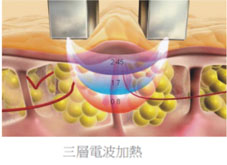 Reaction 電波系統   全身型高階體雕儀介紹(相關圖片)
