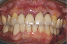 一日植牙Q&A(相關圖片)