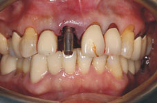 一日植牙Q&A(相關圖片)