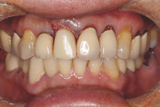 一日植牙Q&A(相關圖片)