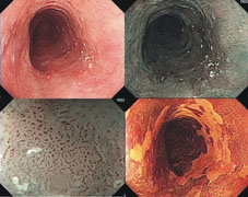 消化系統癌症篩檢  超音波與內視鏡扮演的重要角色(相關圖片)