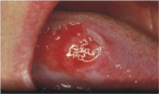 老菸槍、紅唇族注意!別讓口腔癌奪走你的健康人生!(相關圖片)