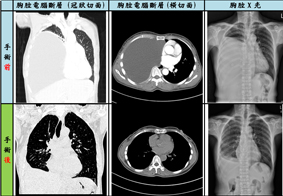 破解13年痼疾  藏在胸腔裡的巨大水瘤 罕病『畸胎瘤』(相關圖片)