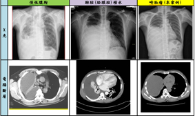 破解13年痼疾  藏在胸腔裡的巨大水瘤 罕病『畸胎瘤』(相關圖片)