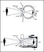 我的世界模糊看不清扭曲變形了！   談白內障及老年性黃斑部病變(相關圖片)
