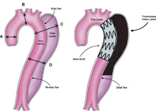 血管支架工程  談主動脈覆膜支架(Stent Graft)(相關圖片)
