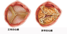 年齡衰老  造成退化性瓣膜疾病(相關圖片)