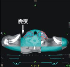 口腔癌新希望  導航螺旋刀治療成效(相關圖片)