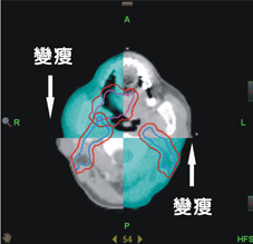 口腔癌新希望  導航螺旋刀治療成效(相關圖片)