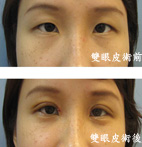 擁有迷人更有電力的雙眼皮(相關圖片)