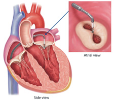 傷口越小越好? 讓您了解目前最新的經導管瓣膜手術(相關圖片)