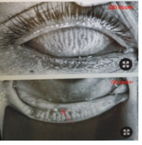 國家生技醫療品質掛保證   缺油！缺水！正確診斷、安全有效治療乾眼症(相關圖片)