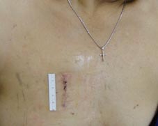 感人的千里生死之旅桃姊的微創主動脈瓣膜置換手術(相關圖片)