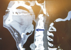 達文西機器手臂是頸部腫瘤切除手術利器(相關圖片)